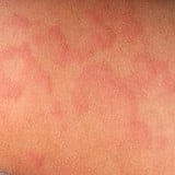 蕁麻疹 肌 皮膚 病気 発疹 湿疹