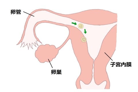 イラスト 卵管卵巣5