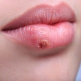 ヘルペス 女性 口
