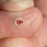 血管拡張性肉芽腫 血管腫 腫瘍