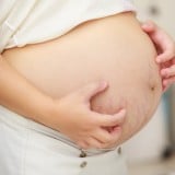 かゆみ 妊娠線 妊婦