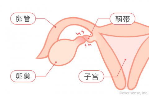 子宮 卵巣 卵管 卵巣捻転