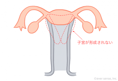 子宮奇形 低形成