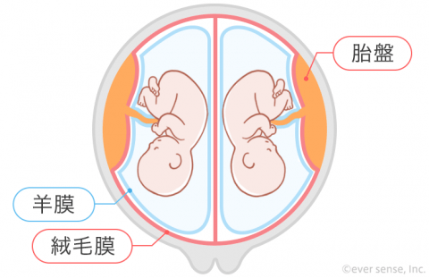 双子 多胎妊娠 二絨毛膜二羊膜双胎 DD双胎