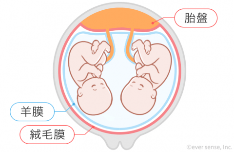 双子 多胎妊娠 一絨毛一羊膜双胎 MM双胎