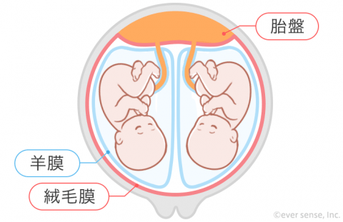 双子 多胎妊娠 一絨毛二羊膜双胎 MD双胎