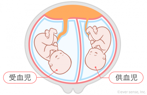 双子 多胎妊娠 双胎間輸血症候群