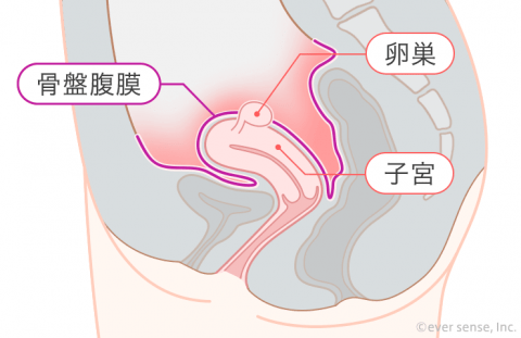 骨盤腹膜炎