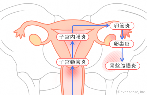 子宮頸管炎 子宮内膜炎 卵管炎 卵巣炎 骨盤腹膜炎