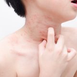 発疹 子供 首