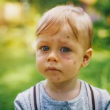 子供 男の子 吹き出物