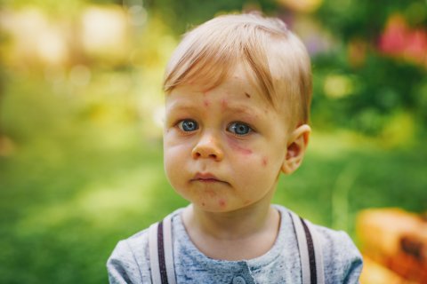 子供 男の子 吹き出物