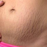 女性 妊娠線