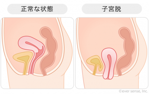 子宮脱 子宮下垂