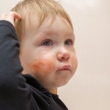 子供 頬 発疹