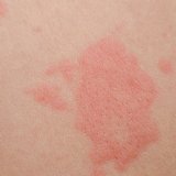 紅斑 妊娠性疱疹 赤み 痒み 湿疹