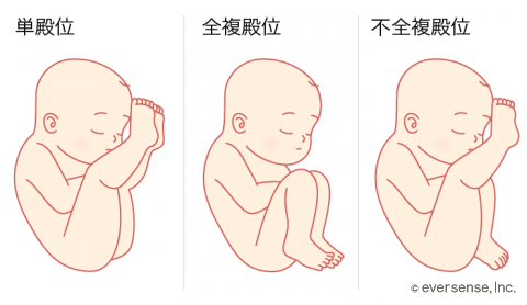 逆子 単殿位 全複殿位 不全複殿位