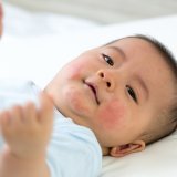 乳児湿疹 日本人 赤ちゃん(アイキャッチ)