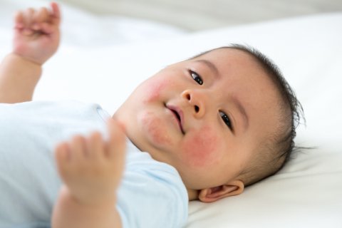 乳児湿疹 日本人 赤ちゃん