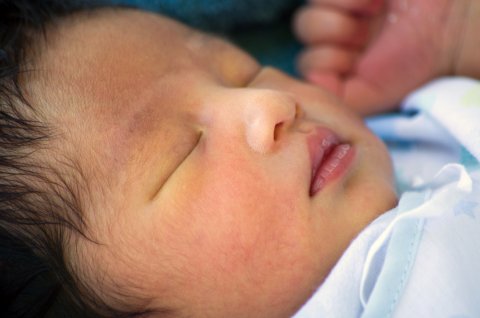 赤ちゃん 黄疸 新生児 日本人