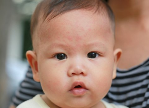 赤ちゃん 湿疹 日本人 アレルギー